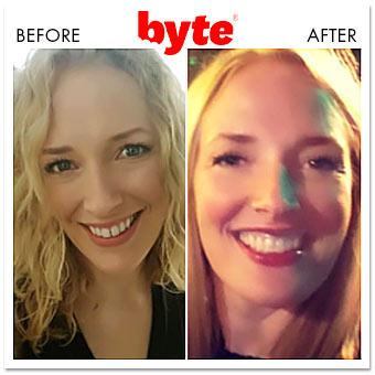 byte before after alison