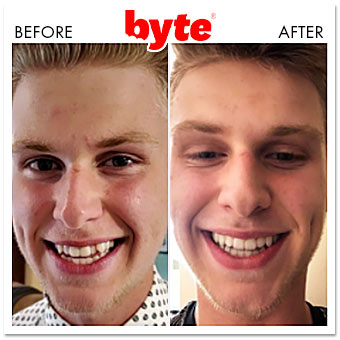 byte before after kevin